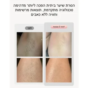 מכשיר להסרת שיער בלייזר ביתי IPL | הסרת שיער לכל הגוף ללא כאב תמונה 2