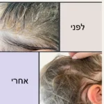 שמפו נגד קשקשים ללא מלחים 3