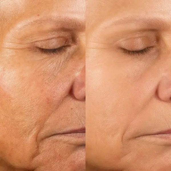 מכשיר מיקרודרמברזיה אישי לשימוש ביתי - תוצאה