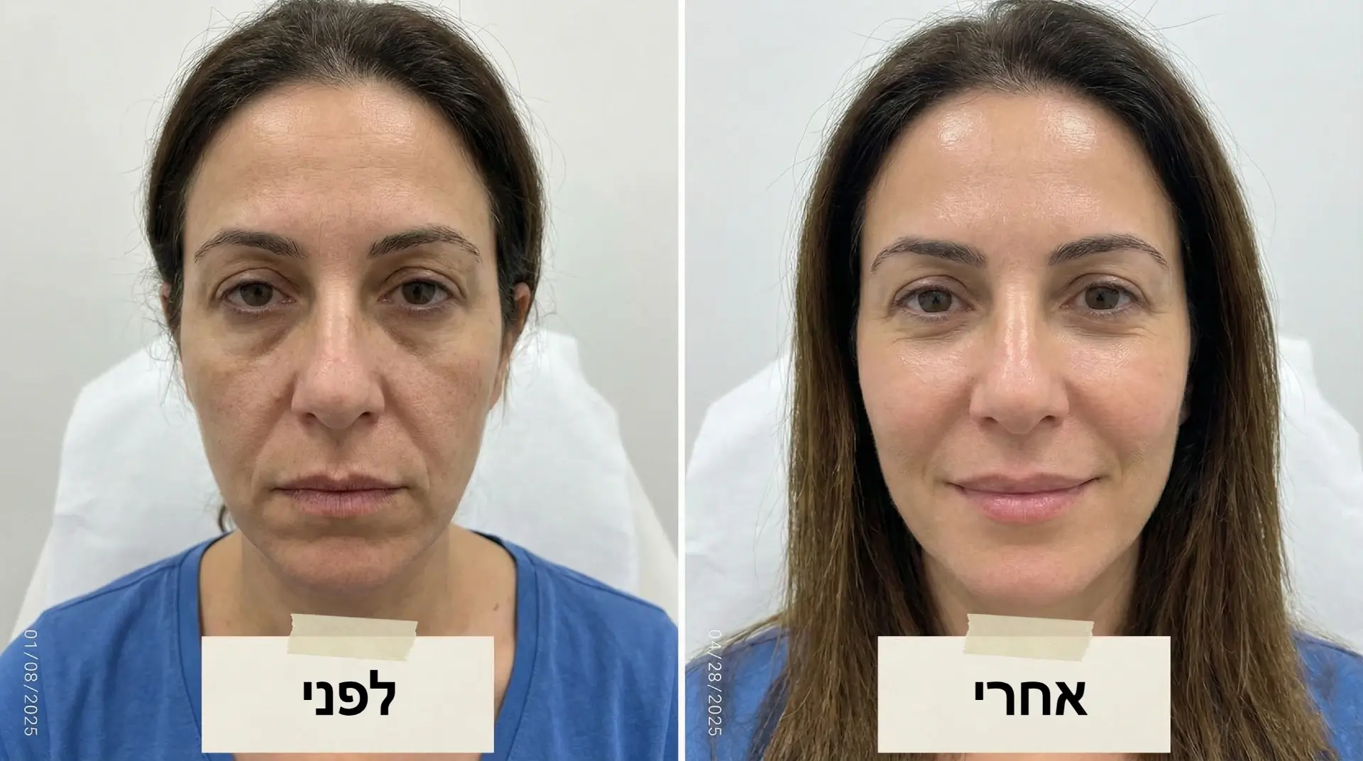 הזרקת חומצה היאלורונית תוצאות לפני ואחרי